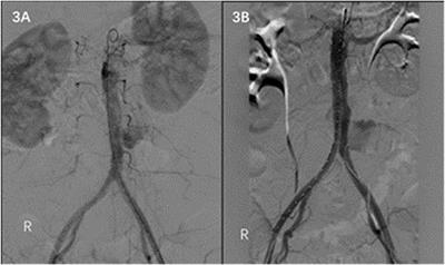 Treatment of abdominal aortic pseudoaneurysm caused by brucellosis with endovascular aneurysm repair